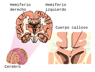 agenesia total de cuerpo calloso