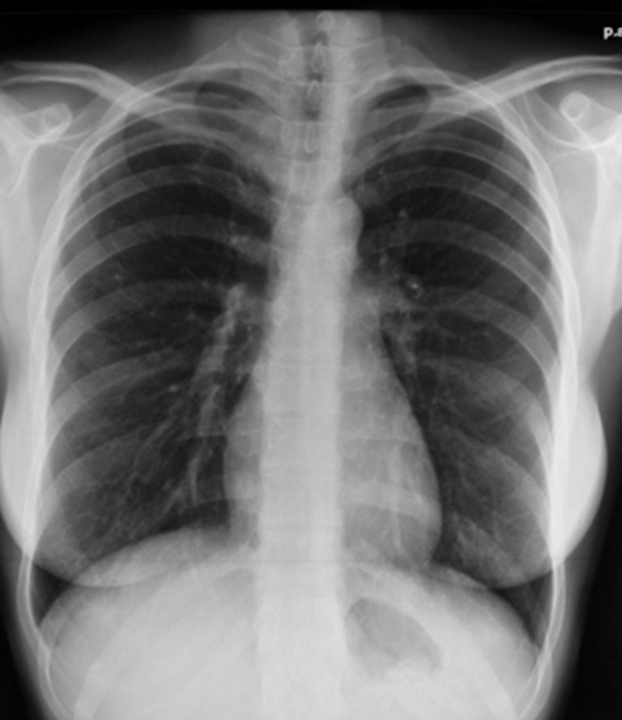 Radiographie Thoracique on emaze Radiographie Thoracique on emaze