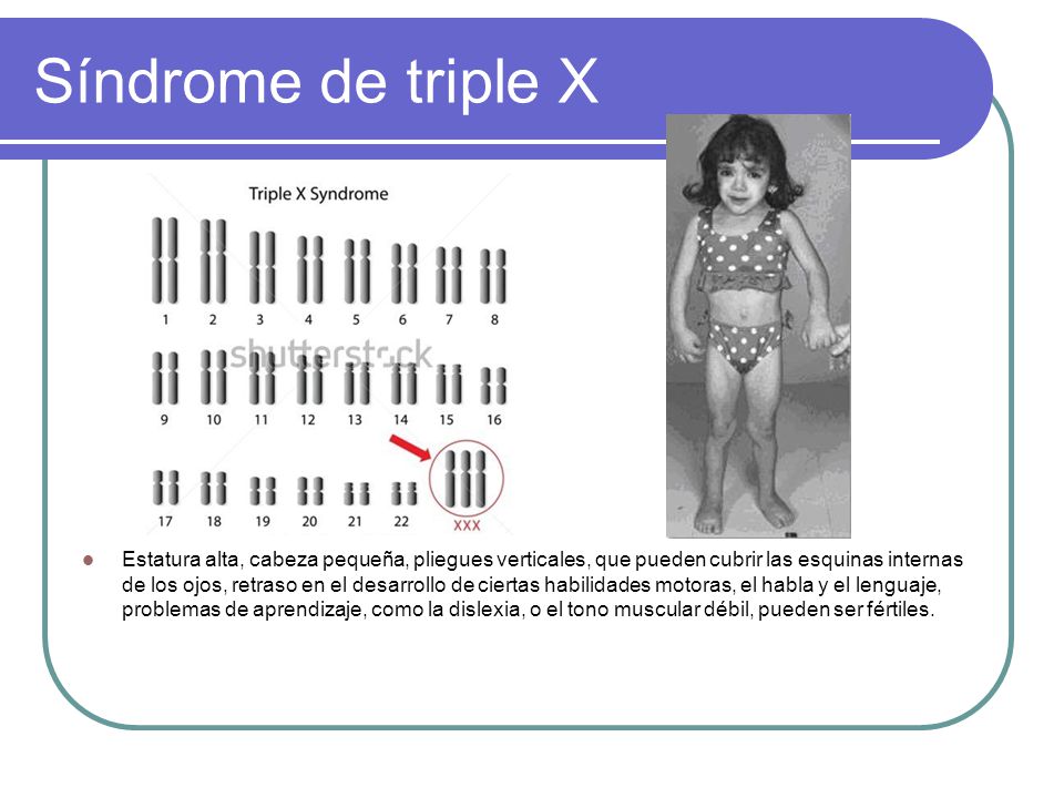 Resultado de imagen para sindrome triple x