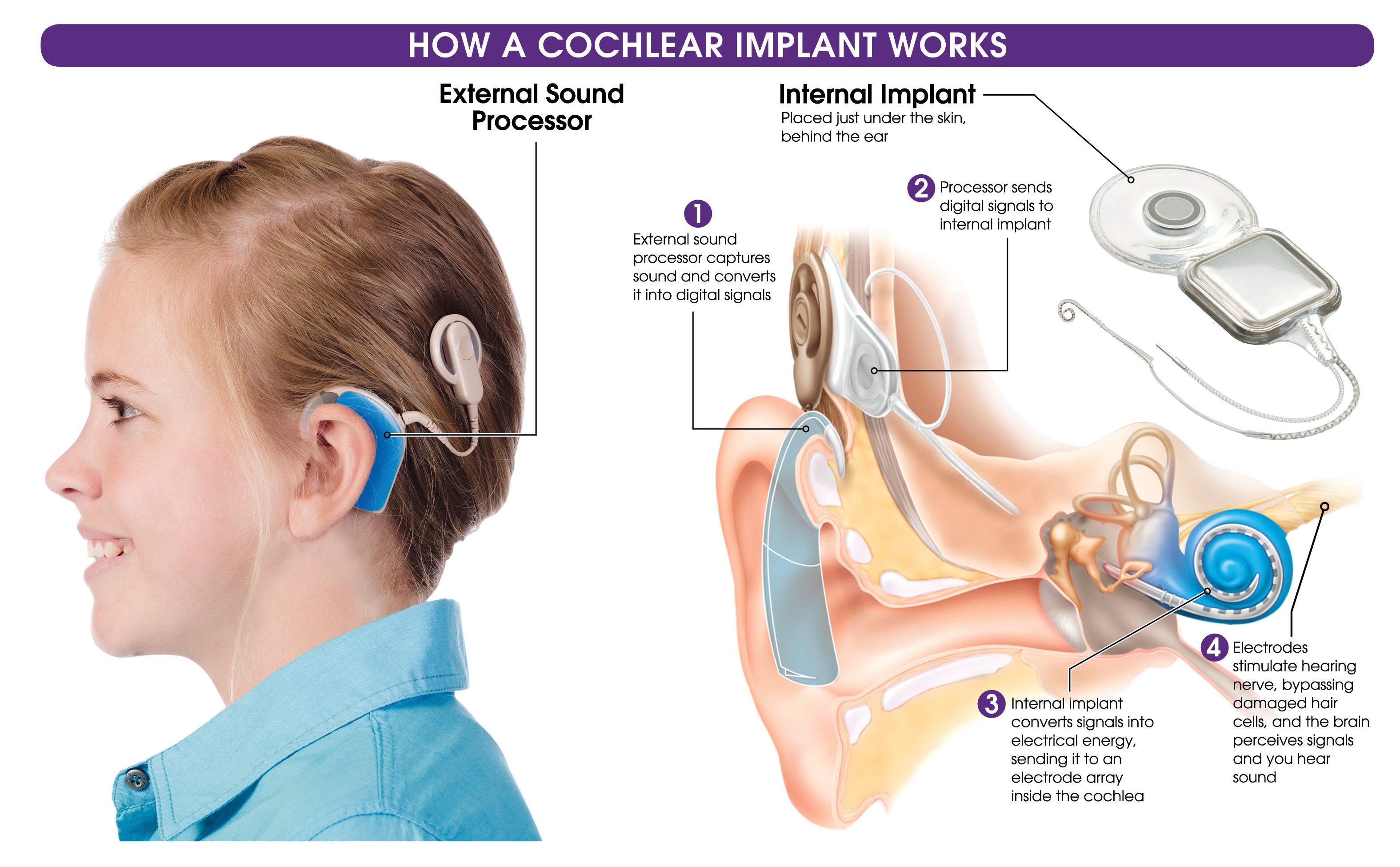 Кохлеарная имплантация что это. Аппарат Cochlear кохлеарный Cochlear. Кохлеарный имплант Кохлер. Слуховой аппарат кохлеарный имплант операция. Ки аппарат для слуха операция.