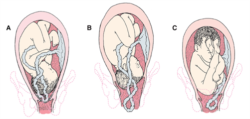 4 беременность 3 роды. Выпадения петель пуповины при родах. Выпала пуповина при родах.