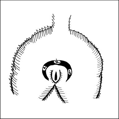 Episioplasty on emaze