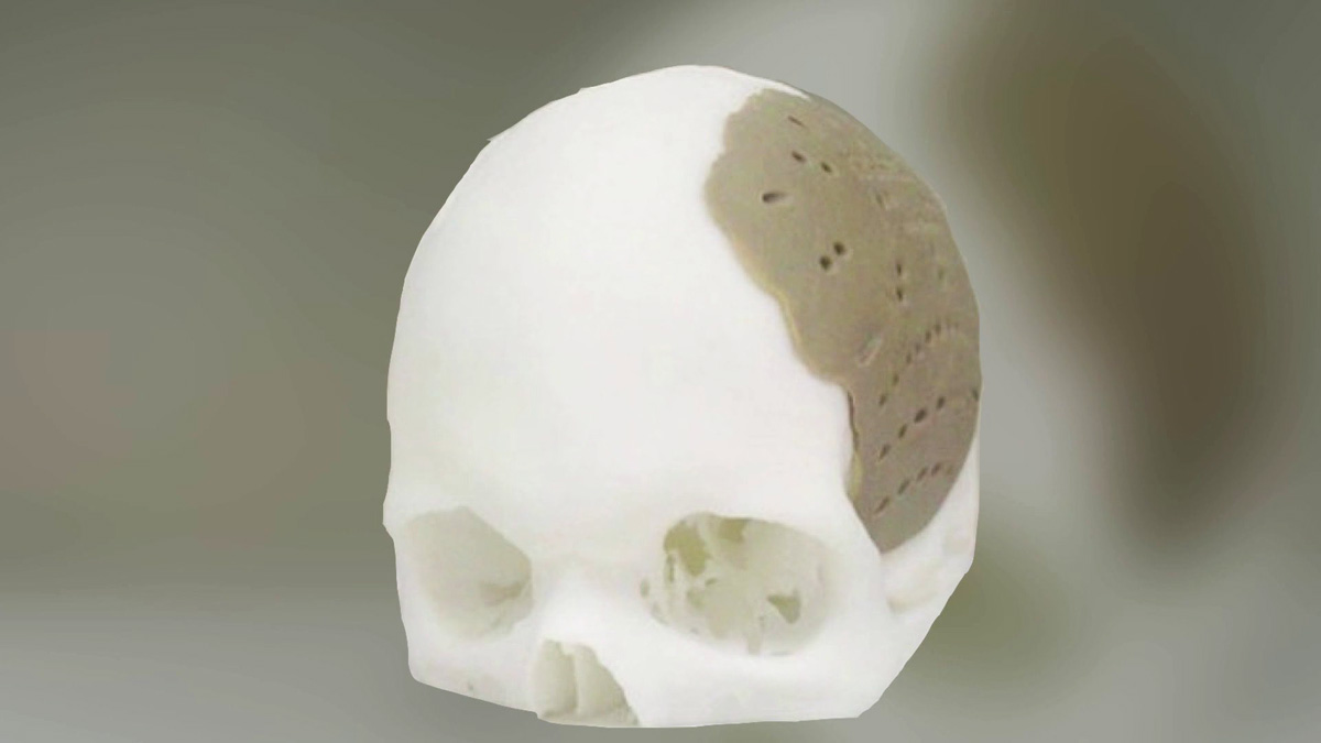 Напечатанные кости. 3d принтер черепушка. Краниопластика 3d принтер. Трансплант черепа на 3д принтере в России. Имплант на 3д принтере.