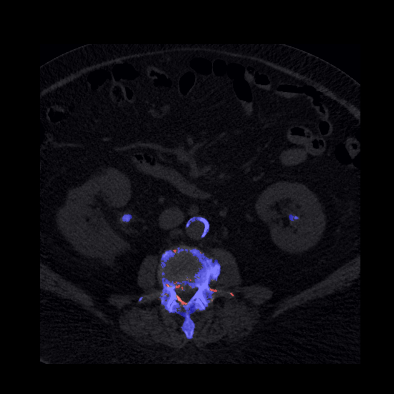 Dual Energy CT on emaze