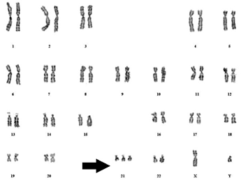 трисомия по х хромосоме механизм возникновения. мозаичная форма синдрома дауна кариотип. синдром трисомии кариотип. трисомиями это.
