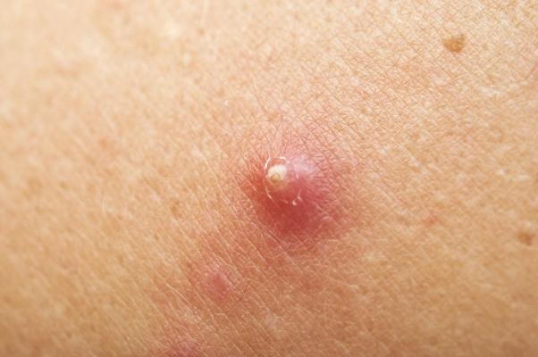 Cura el Absceso de Grasa Axilar Absceso de grasa en la axila