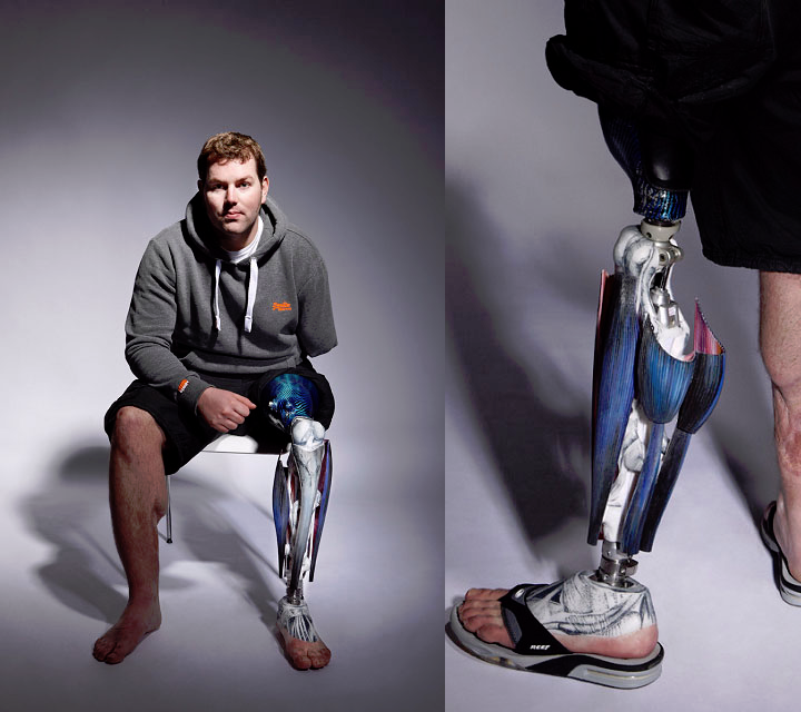 Дизайнерские протезы. Современные протезы. Современные протезы ног. Бионический протез ноги.