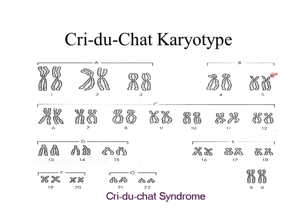 Cri Du Chat Syndrome By S V R35 On Emaze