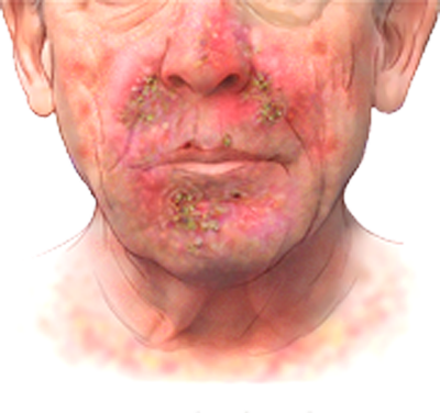 Egfr Associated Rash EGFR-Associated Rashes at emaze Presentation