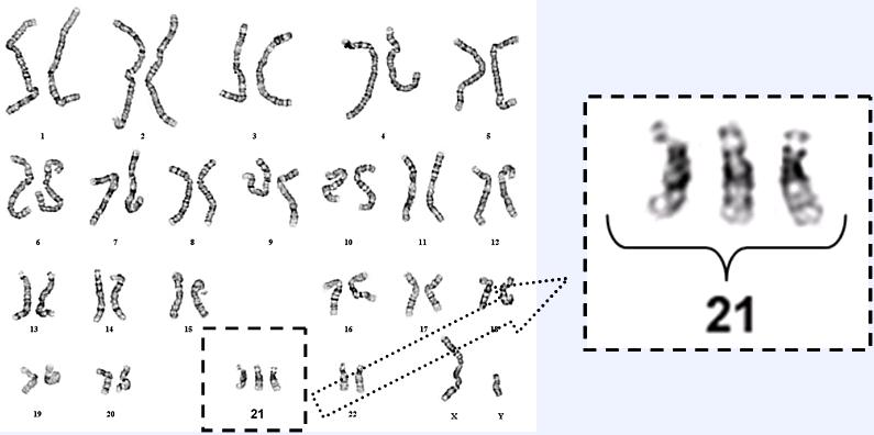 21 хромосома. Синдром Дауна схема хромосом. Синдром Дауна хромосомы. Синдром Дауна 21 хромосома. Синдром Дауна лишняя хромосома.
