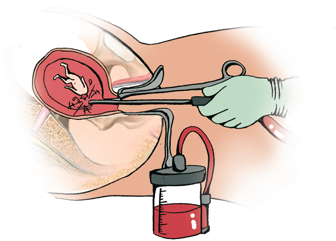 Resultado de imagen para el aborto INDUCIDO
