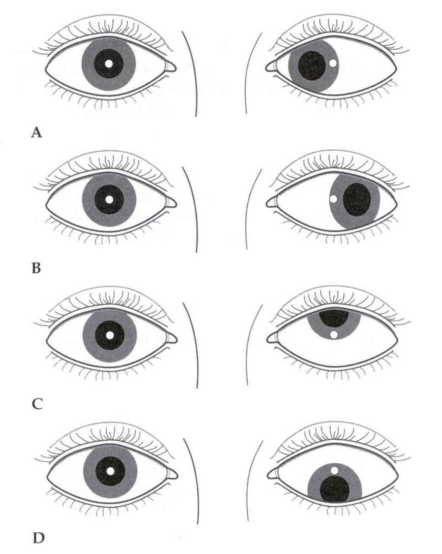 Домашний глаз прямой. Гетерофория косоглазие. Классификация косоглазия офтальмология. Скрытое косоглазие экзотропия. Косоглазие 1 степени.