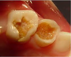 Resultado de imagen para caries DE LA DENTINA PROFUNDA