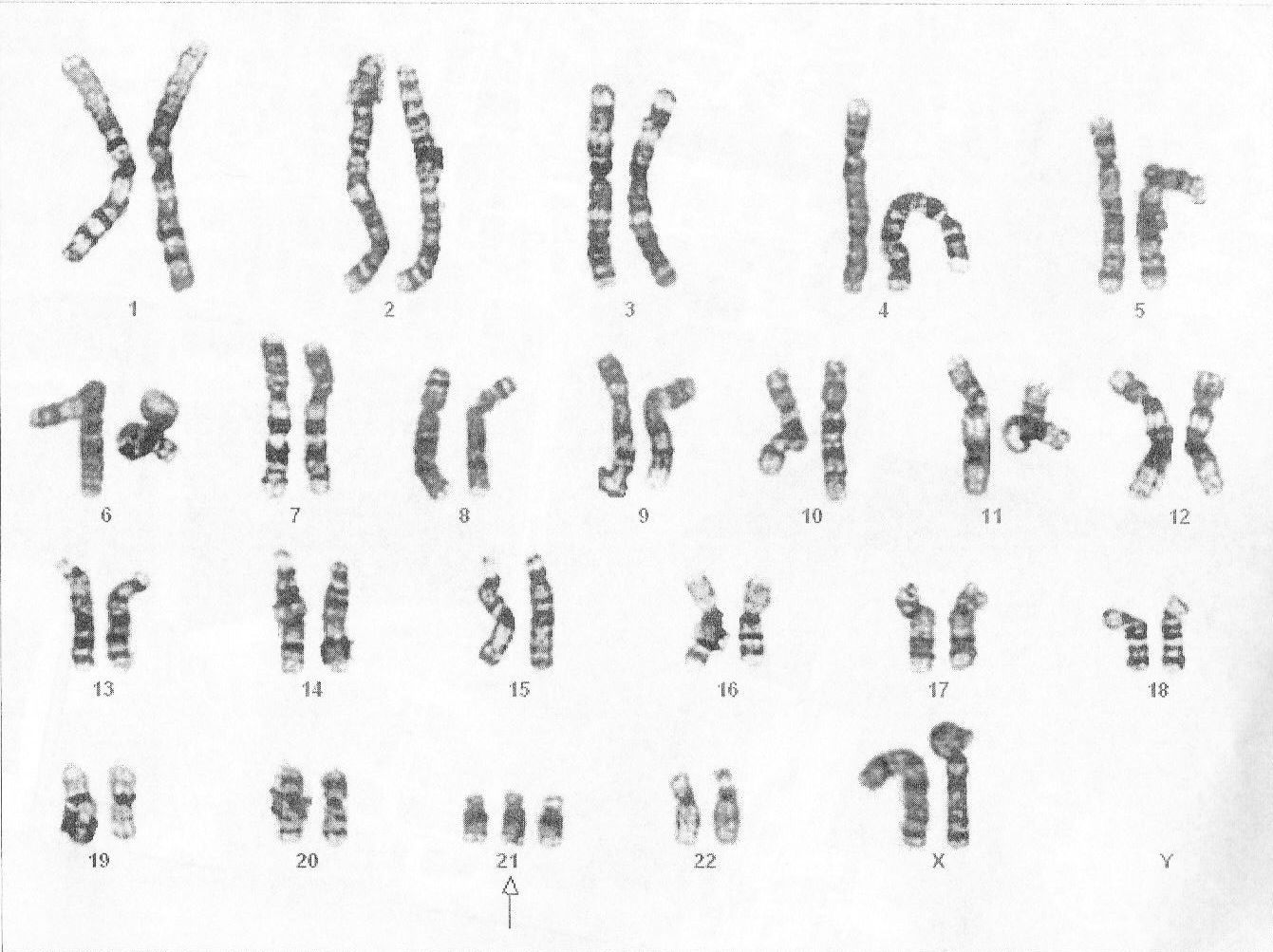 Синдром дауна лишняя хромосома. Синдром Дауна кариотип. Синдром Дауна 21 хромосома. Кариотип человека с синдромом Дауна. Трисомия по 21 хромосоме кариотип.