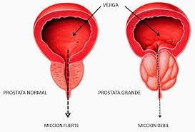 la gonorrea puede causar prostatitis la gonorrea puede causar prostatitis