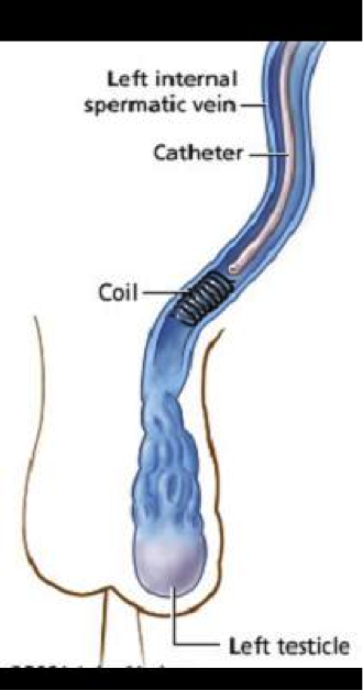 Варикоцеле Яйцах Фото