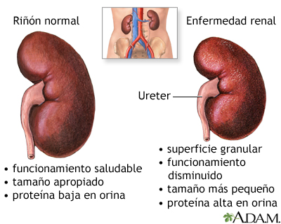 engrosamiento del uréter