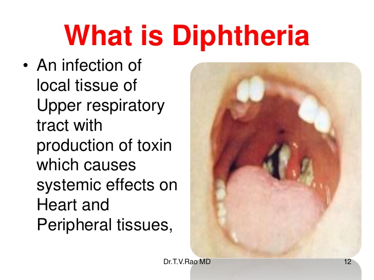 Diphtheria At Emaze Presentation