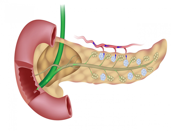 Поджелудочная недостаточность