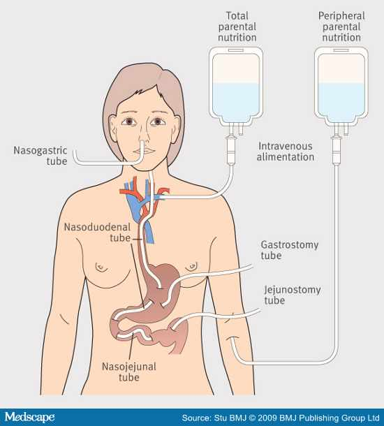 Resultado de imagen de NutriciÃ³n parenteral