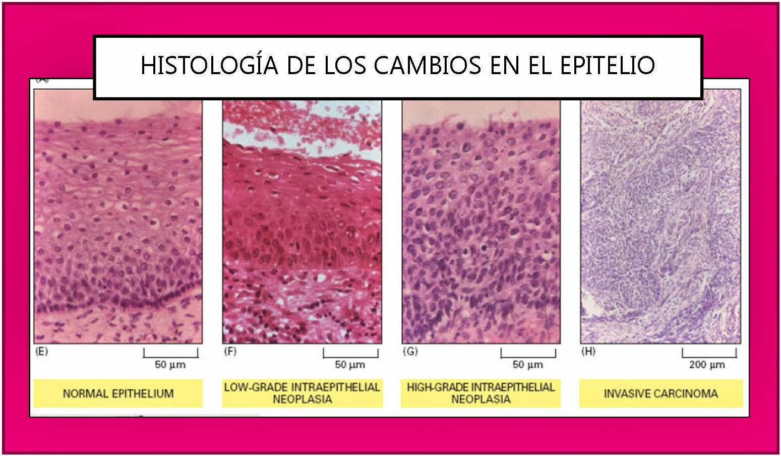 Признаки интраэпителиальной неоплазии. Гистологический признак “carcinoma in situ” (рак на месте):. Carcinoma epidermoide фарингоскопия.