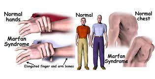 Marfan Syndrome By 24079 On Emaze