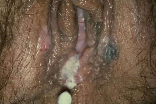 Vaginal Yeast Infection