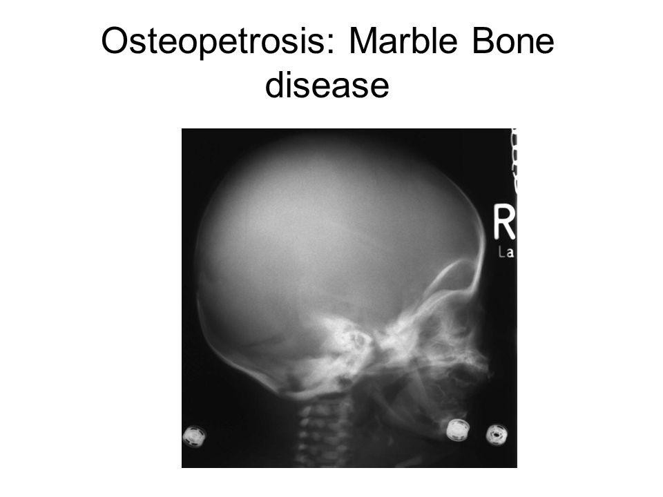 Marble Bone Disease at emaze Presentation