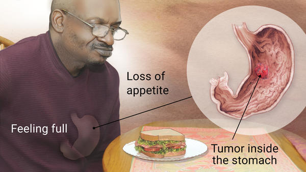 Alimentacion para cancer de estomago
