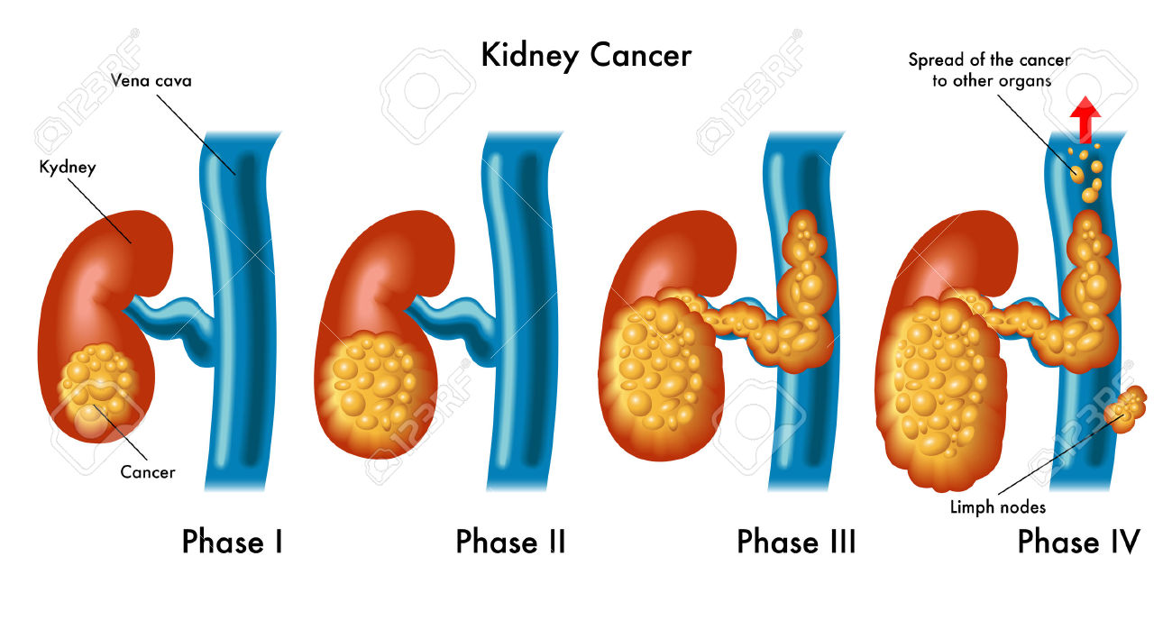 kidney-cancer-on-emaze