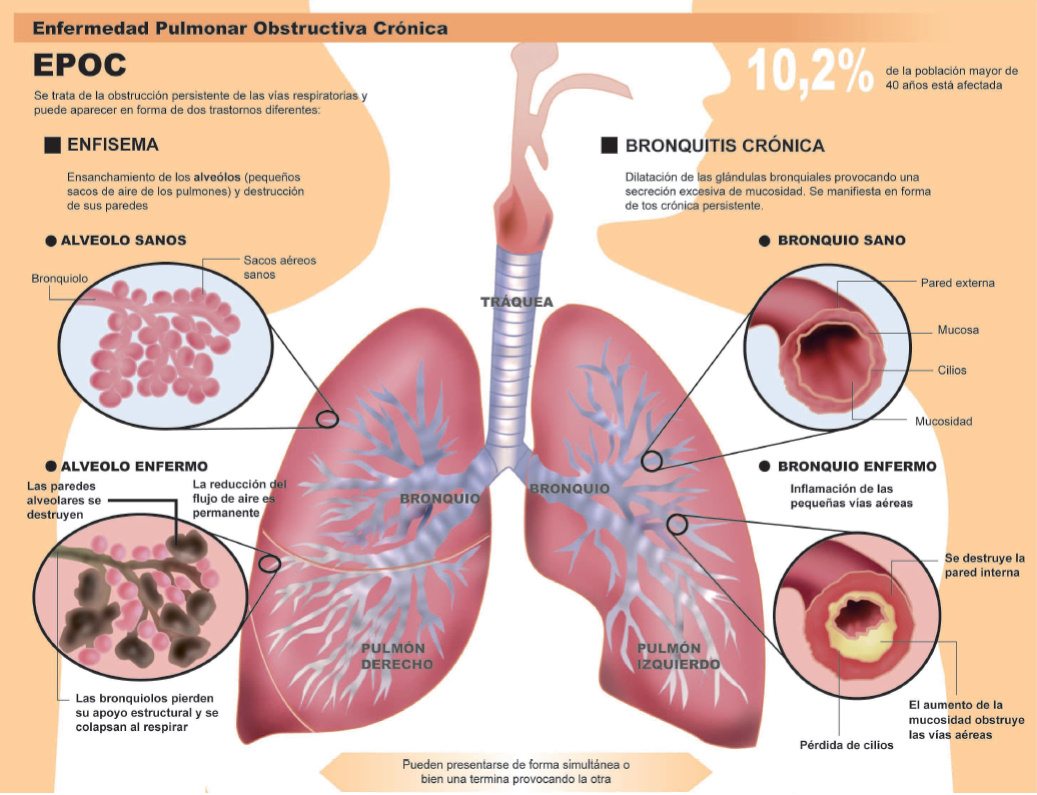 Se puede trabajar con enfisema pulmonar