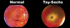 Cherry-Red Spot in Tay–Sachs Disease