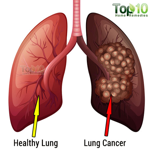 Lung Cancer Project at emaze Presentation