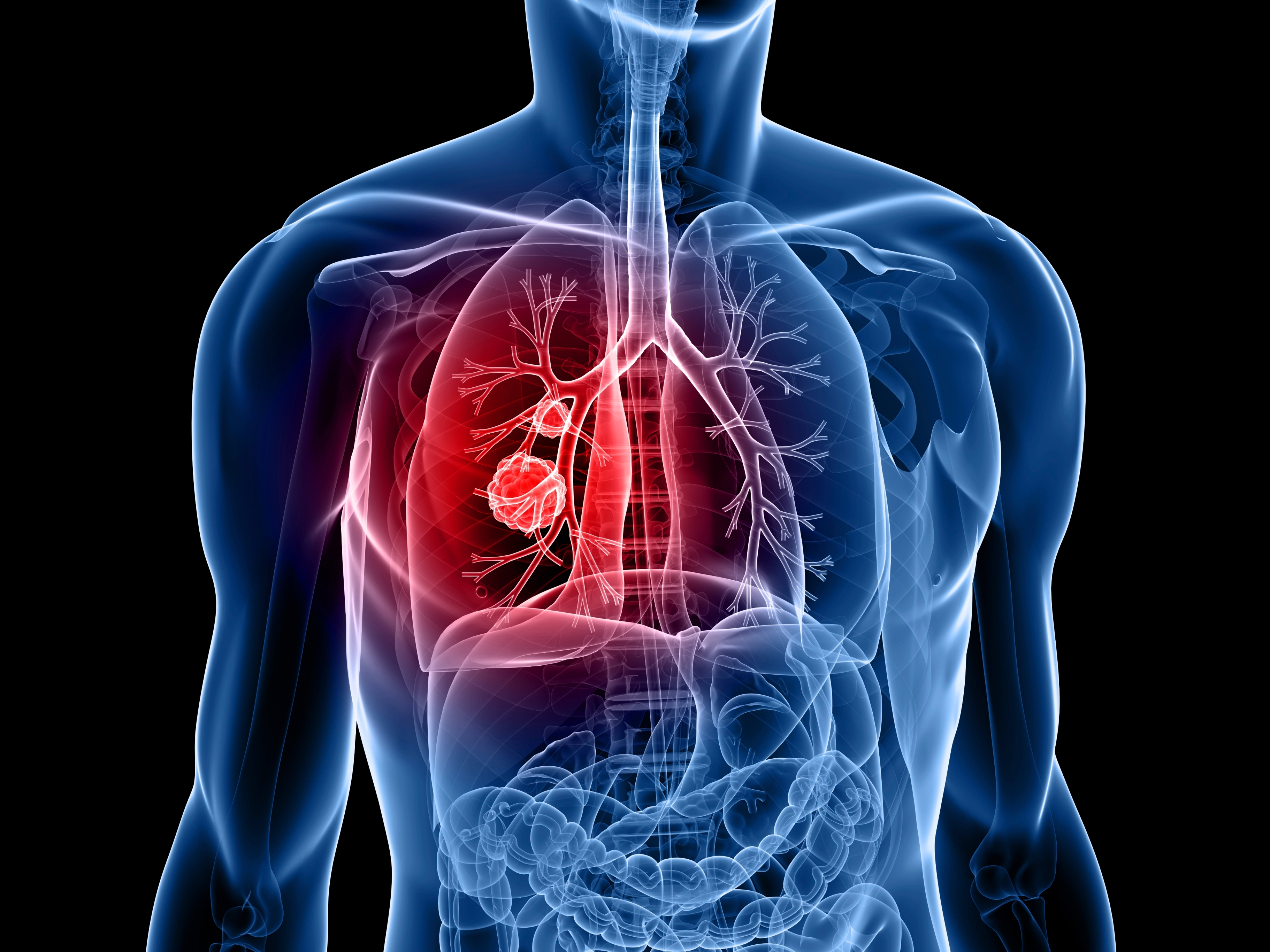 lung-cancer-project-on-emaze