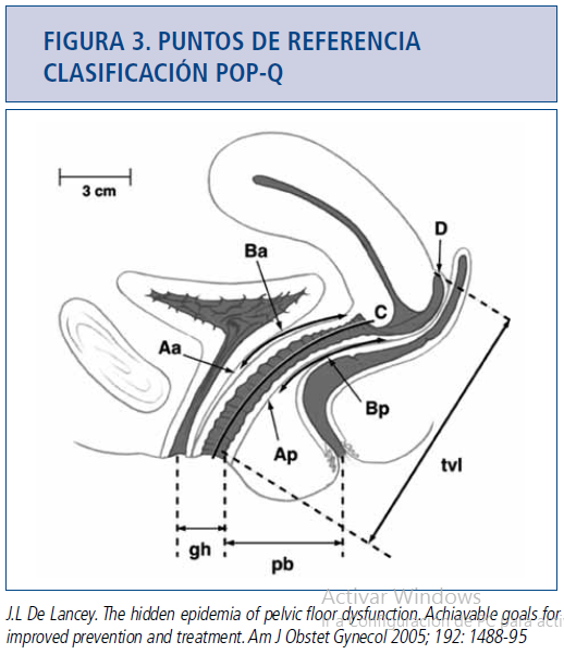 Q классификация. Классификация Pop-q Pelvic. Классификация Pop-q Pelvic Organ prolapse quantification System. Pop q классификация пролапса. Классификация пролапса гениталий рор-q.