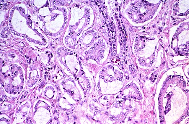 histologia do cancer de prostata histologia do cancer de prostata