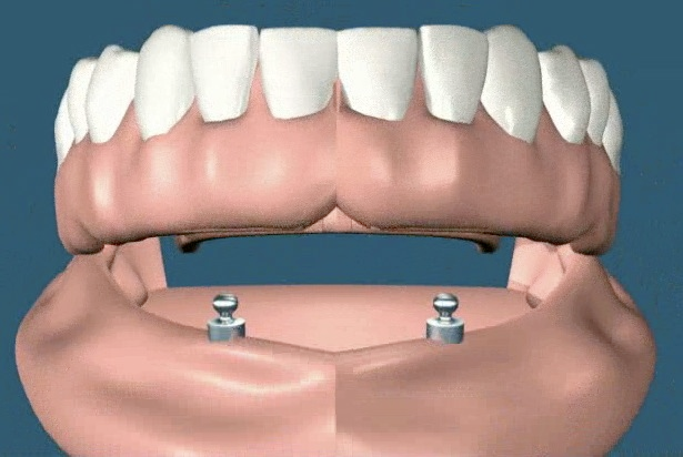 Съемный протез на двух имплантах. Съемный протез на 2 имплантах. Протез на 2 имплантах на нижнюю челюсть. Протез на 2 имплантатах на нижней челюсти.