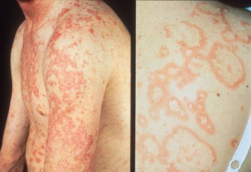 Systemic Lupus Erythematosus on emaze