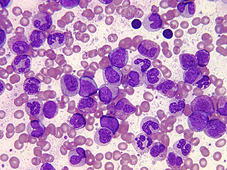 Лимфобласты в крови фото под микроскопом
