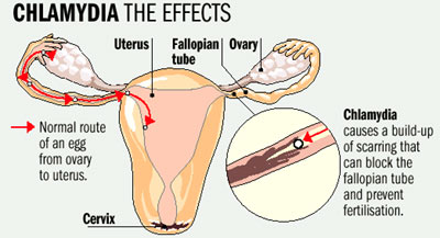 CHLAMYDIA on emaze