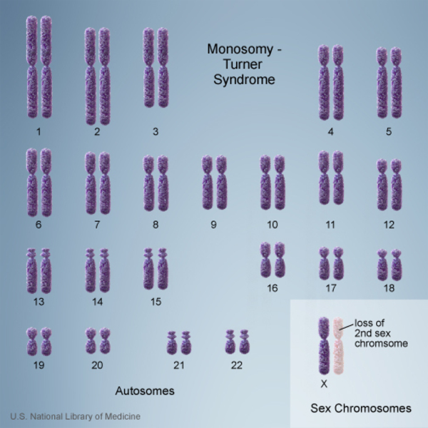 Turners Syndrome on emaze