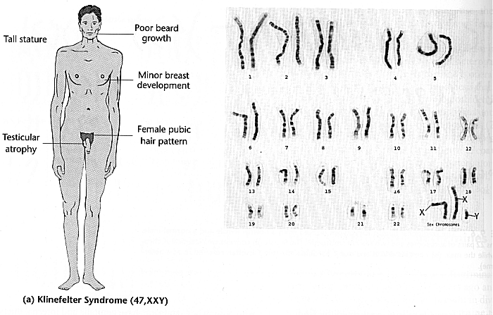 47 Xxy Diagram Klinefelter Syndrome
