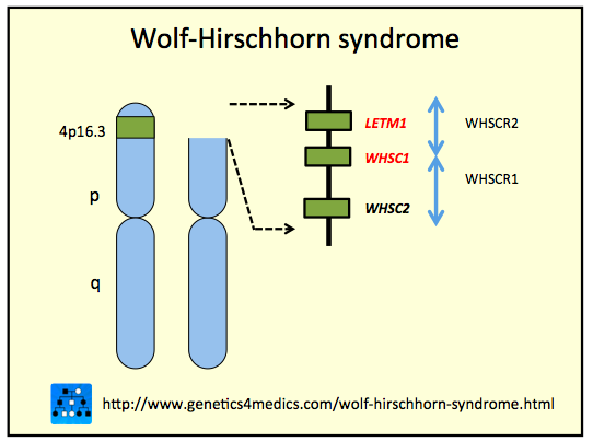 Синдром 4 хромосома. Синдром Вольфа-Хиршхорна. Синдром Вольфа-Хиршхорна кариотип. Синдром Вольфа-Хиршхорна кардиограмма.