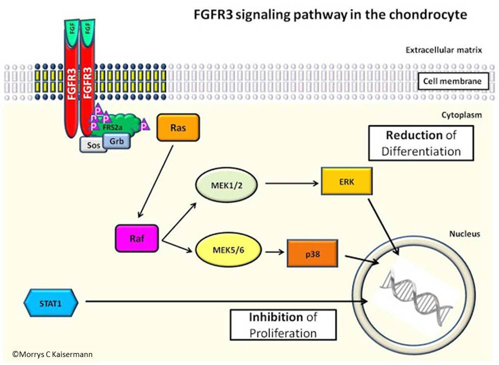 Achondroplasia on emaze