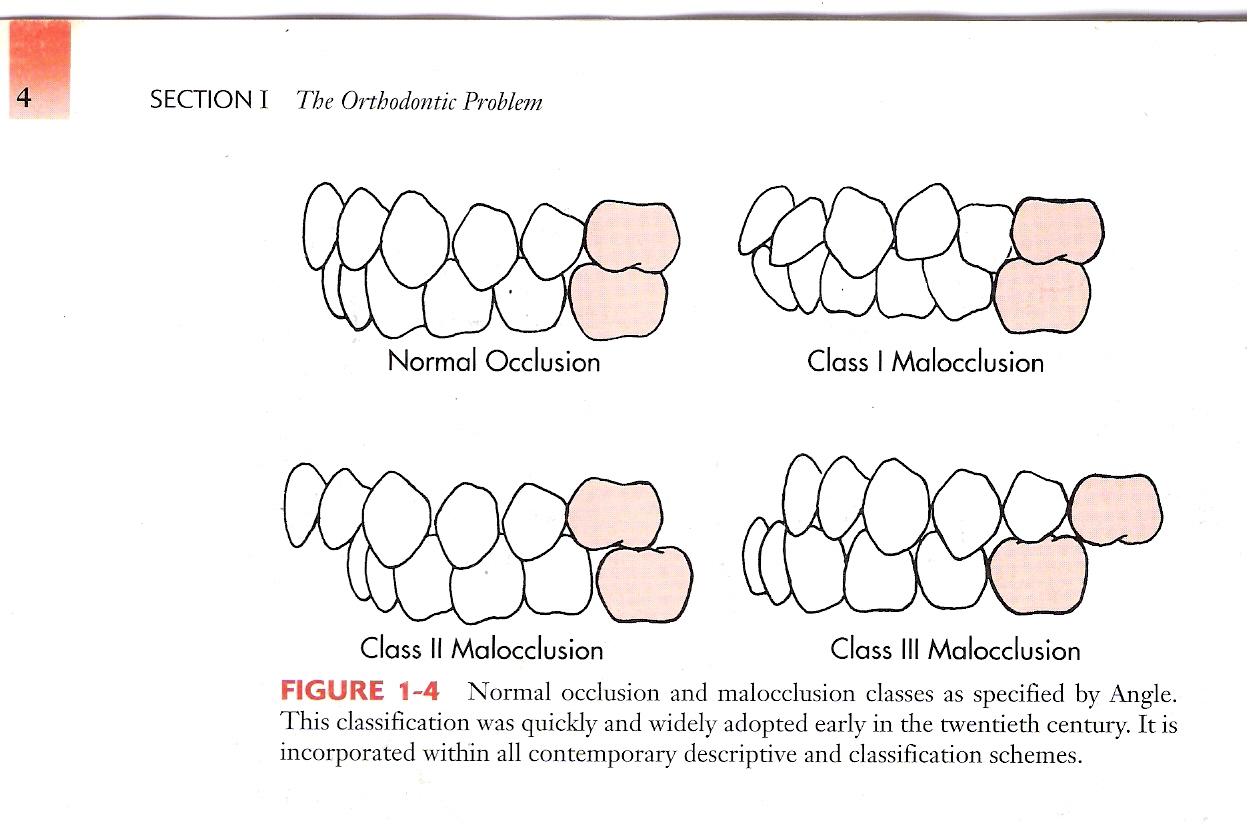 Dental Occlusion Classification Chart Porn Sex Picture
