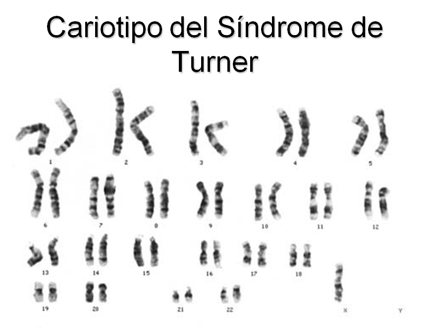 Кариотип 45. Синдром Тернера кариотип. Кариотип Шерешевского-Тернера. Синдром Шерешевского Тернера кариотип. Синдром Шерешевского кариотип.