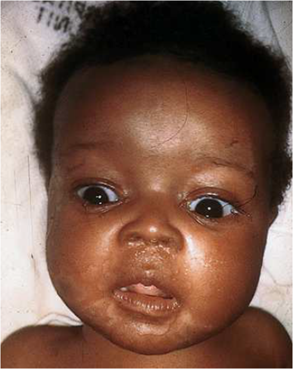 Sífilis Congénita on emaze