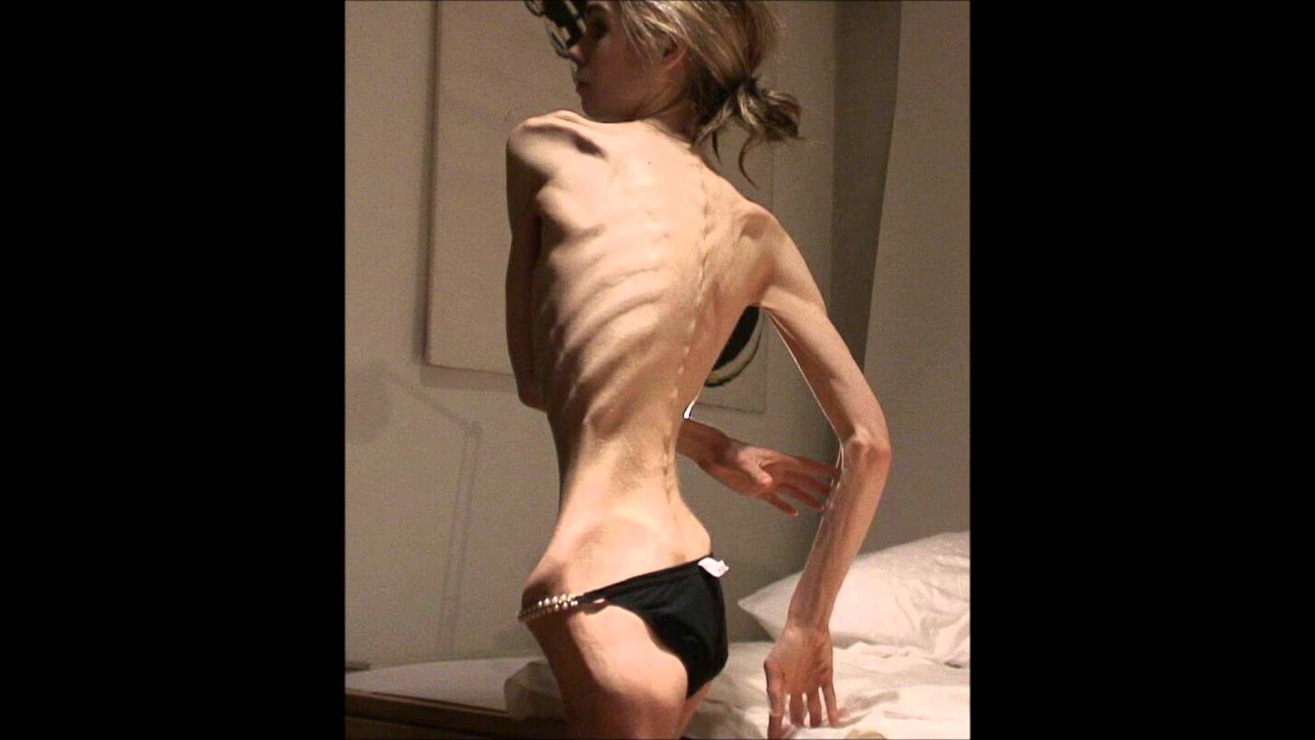 Anorexia. 