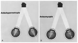 Anisometropía On Emaze