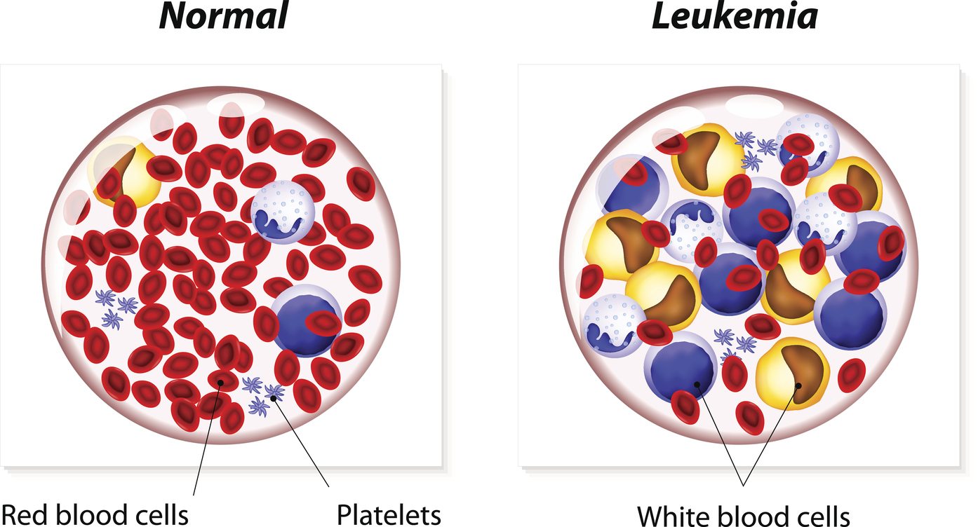 Лейкоз и нормальная кровь